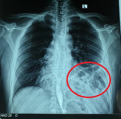 Chàng trai 25 tuổi tức ngực tưởng bị hậu COVID-19, đi khám mới biết vỡ cơ hoành, nội tạng &quot;chui hết&quot; lên phổi - Ảnh 1.