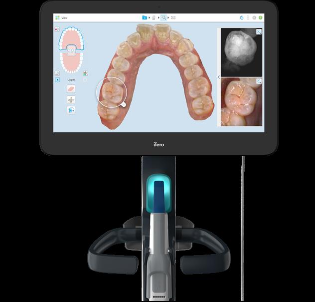 Ra mắt công nghệ scan dấu răng iTero 5D Plus - Ảnh 1.