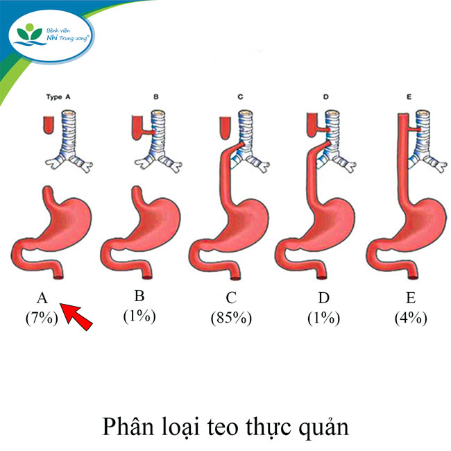 Bé gái bị teo thực quản hiếm gặp phép màu đã xuất hiện - Ảnh 1.