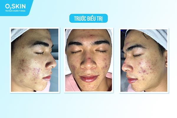Cảnh báo những hậu quả khó lường khi tự trị mụn tại nhà - Ảnh 2.