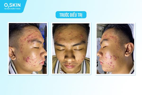 Cảnh báo những hậu quả khó lường khi tự trị mụn tại nhà - Ảnh 3.