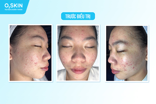 Cảnh báo những hậu quả khó lường khi tự trị mụn tại nhà - Ảnh 4.