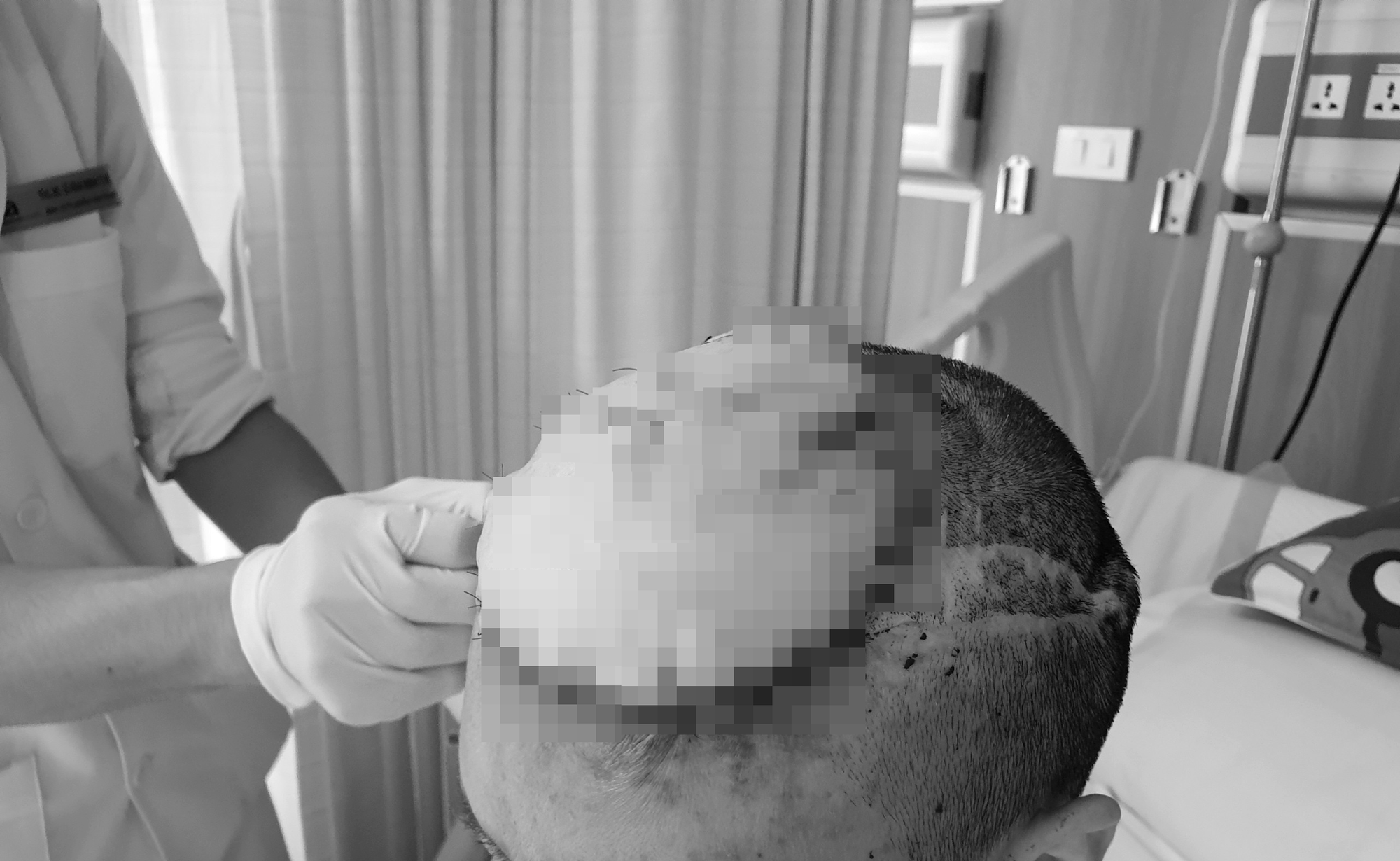 Nhiều năm mang khối u ác tính xuyên sọ to bằng quả bưởi trên trán - Ảnh 2.