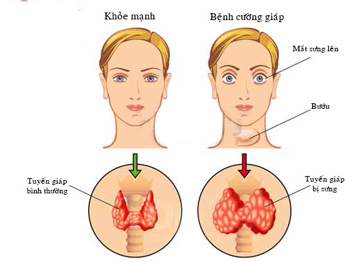 Bệnh cường giáp của hoa hậu Phương Khánh là gì, dấu hiệu nhận biết ra sao? - Ảnh 3.