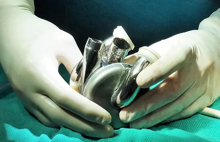 Úc phát triển thiết bị cấy ghép tim đột phá, mở ra hy vọng mới cho bệnh nhân suy tim - Ảnh 2.