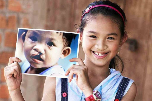 Từ ngày 10 - 14/1, trẻ em Lạng Sơn được phẫu thuật miễn phí dị tật khe hở môi, vòm miệng - Ảnh 1.