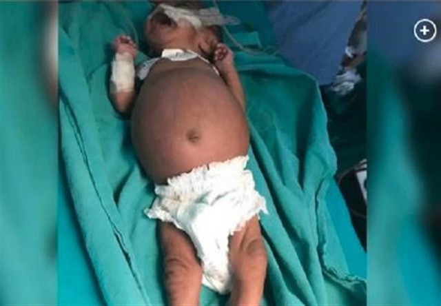 Bé gái sinh ra với chiếc bụng sưng to bất thường, vài ngày sau vẫn không thuyên giảm, nhập viện thì bác sĩ mổ ra đứa trẻ thứ 2 - Ảnh 1. Bé gái sinh ra với chiếc bụng sưng to bất thường, vài ngày sau vẫn không thuyên giảm, nhập viện thì bác sĩ mổ ra đứa trẻ thứ 2 - Ảnh 1.