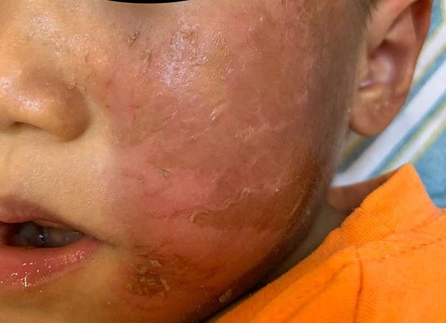 Đeo mặt nạ siêu nhân hóa trang Halloween, bé trai 4 tuổi bị bỏng rộp da mặt - Ảnh 1.