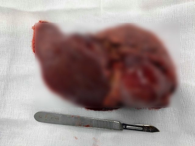 Phẫu thuật nội soi cắt gan thành công cho bệnh nhân ung thư gan - Ảnh 1.