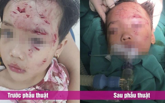 Phú Thọ: Bé gái 3 tuổi bị chó nhà hàng xóm cắn thương tâm - Ảnh 1.