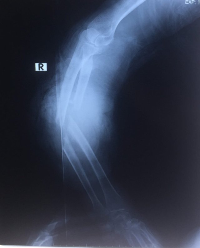 Nối thành công cẳng tay cho bệnh nhân bị máy cưa cắt gần đứt lìa - Ảnh 2.