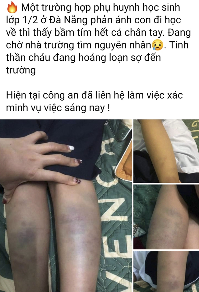 Xác minh thông tin “học sinh tiểu học bị đánh bầm tím chân tay” - Ảnh 1.
