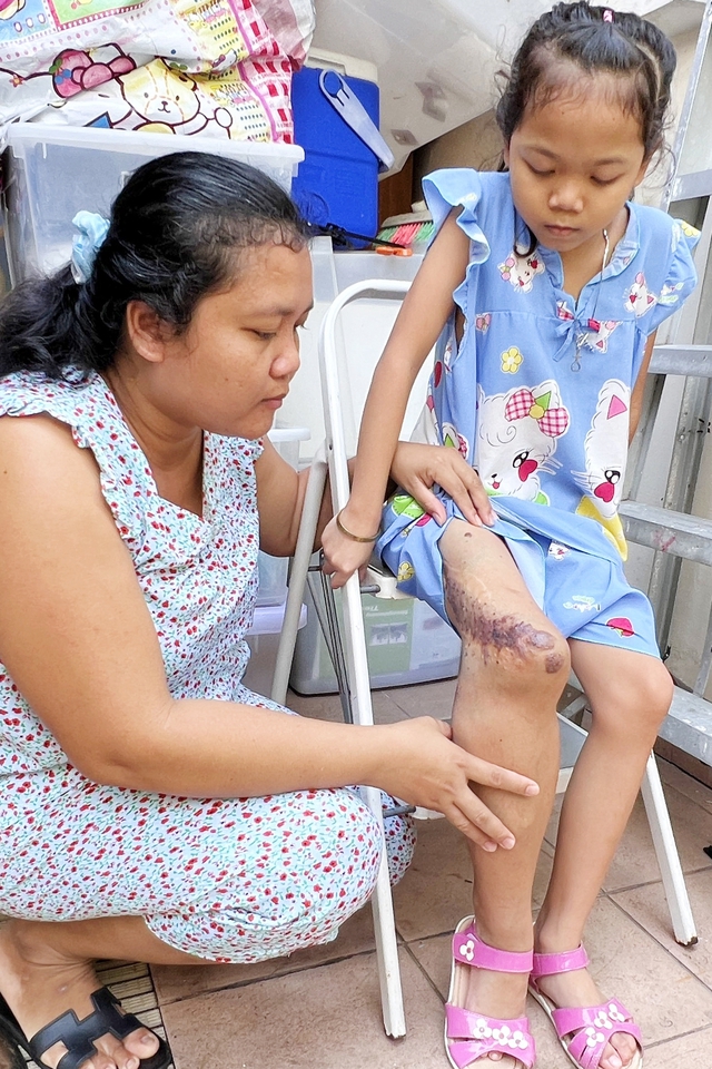 Hi vọng mong manh của bé gái 9 tuổi bị bướu máu ác tính, có thể cắt bỏ chân nếu không được chữa trị - Ảnh 3.