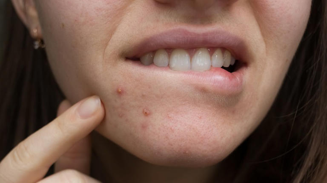 Nguyên nhân gây ra mụn quanh môi và cách bạn có thể ngăn ngừa nó - Ảnh 1.