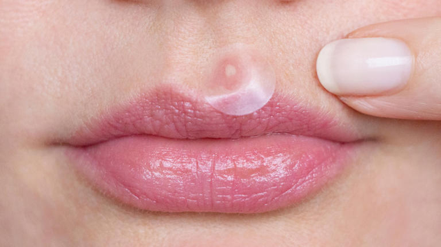 Nguyên nhân gây ra mụn quanh môi và cách bạn có thể ngăn ngừa nó - Ảnh 2.
