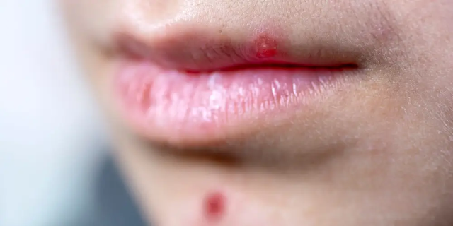 Nguyên nhân gây ra mụn quanh môi và cách bạn có thể ngăn ngừa nó - Ảnh 3.