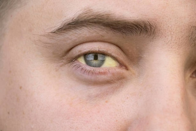 3 dấu hiệu ở mắt cảnh báo đột quỵ, ung thư 'ghé thăm' - Ảnh 1.