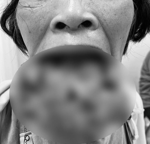 Ăn thực dưỡng tự điều trị bệnh, người phụ nữ mang khối u môi dưới lở loét với kích thước khủng - Ảnh 1.