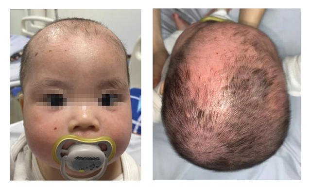 Bé trai bong tróc toàn bộ da mặt và da đầu do tắm lá điều trị viêm da cơ địa - Ảnh 2.