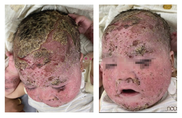 Bé trai bong tróc toàn bộ da mặt và da đầu do tắm lá điều trị viêm da cơ địa - Ảnh 1.