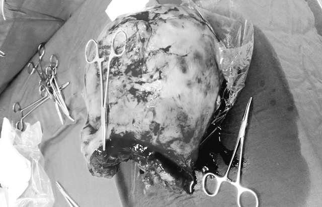 Quảng Trị: Mổ lấy thai kết hợp cắt khối u 4kg cho một sản phụ - Ảnh 1.