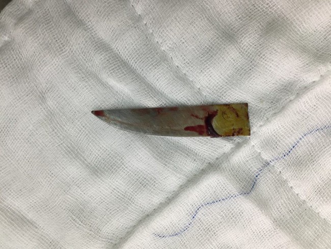 Lưỡi dao 6cm đâm xuyên lưng thấu tới ngực người đàn ông - Ảnh 2.
