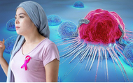 BS chuyên khoa chỉ ra dấu hiệu nhận biết 5 loại ung thư phổ biến tại Việt Nam hiện nay