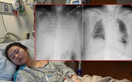 Chụp X-quang phát hiện nhiều người trẻ phổi trắng xóa, nguyên nhân vì đâu?