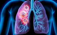 2 vợ chồng cùng mắc ung thư phổi: Bác sĩ chỉ ra nguyên nhân