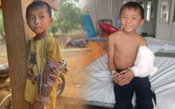 Ca phẫu thuật của cậu bé vùng cao dùng củi khô nẹp tay gãy: “Em bảo đau lắm, nhưng vẫn lạc quan” 