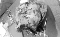 Quảng Trị: Mổ lấy thai kết hợp cắt khối u 4kg cho một sản phụ