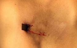 Lưỡi dao 6cm đâm xuyên lưng thấu tới ngực người đàn ông