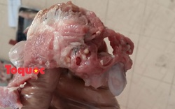Hơn 100 người ở Bình Phước nhiễm ấu trùng sán dây lợn