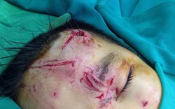Kinh Hoàng: Bé trai 7 tuổi bị chó nhà cắn nát mặt