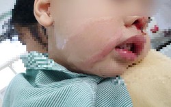 Mẹ bất cẩn nhỏ nhầm axit vào mũi con trai 2 tuổi