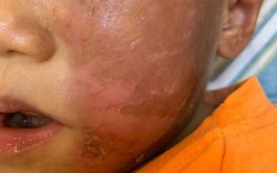 Đeo mặt nạ siêu nhân hóa trang Halloween, bé trai 4 tuổi bị bỏng rộp da mặt