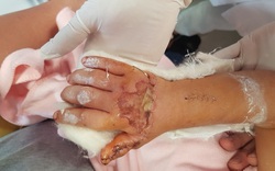 Gia đình bất cẩn, bé 3 tuổi bị máy dập cốc cán nát bàn tay