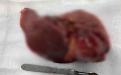 Phẫu thuật nội soi cắt gan thành công cho bệnh nhân ung thư gan