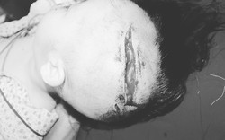 Hà Nội: Bé 2 tuổi bị chó cắn lòi cả xương sọ