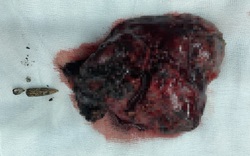 Gắp đầu đạn nằm trong phổi hơn 60 năm cho bệnh nhân