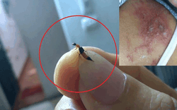 Nhiều người bị viêm da do tiếp xúc với kiến ba khoang: Phân biệt kiến ba khoang đốt và bệnh zona