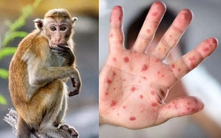 Việt Nam có ca nhiễm đậu mùa khỉ đầu tiên: Tất cả những điều cần biết để phát hiện và phòng bệnh