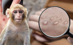 Thấy da nổi những nốt phát ban thế này, cần cảnh giác với bệnh đậu mùa khỉ