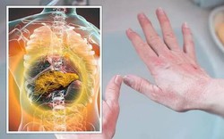 Dấu hiệu ở lòng bàn tay cảnh báo bệnh gan nhiễm mỡ tăng nặng hoặc 6 bệnh nguy hiểm khác