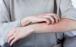 Kiểu dị ứng thường gia tăng trong mùa đông và cách phòng chống hiệu quả cho cả gia đình
