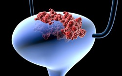 2 triệu chứng phổ biến nhất của ung thư bàng quang, có 1 cũng cần đi khám ngay