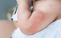 Dị ứng ở trẻ em, đã tìm ra nguyên nhân và cách có thể 