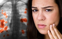 Dấu hiệu cảnh báo ung thư phổi xuất hiện ngay trên khuôn mặt, nếu chú ý có thể phát hiện bệnh giai đoạn sớm