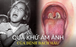 Bệnh bạch hầu từng là 