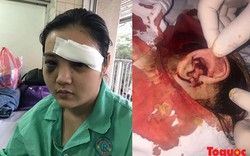 TP HCM: Bị đánh đập dã man, một thiếu nữ nguy cơ bị mù mắt trái